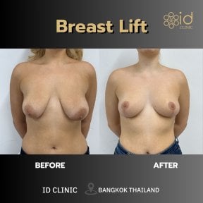 Before and after breast lift results at ID Clinic Bangkok, improved breast shape and contour