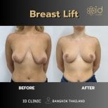 Before and after breast lift results at ID Clinic Bangkok, improved breast shape and contour