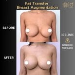 Before and after fat transfer breast augmentation results at ID Clinic Bangkok, enhanced volume