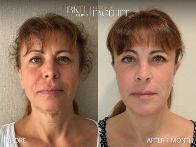 Resultados antes y después de deep plane facelift en BKFL Clinic – rejuvenecimiento facial visible