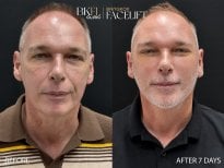 Resultados antes y después de deep plane facelift en BKFL Clinic – rejuvenecimiento facial visible