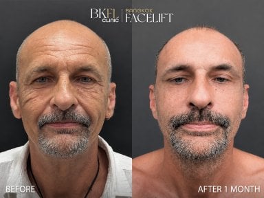 Resultados antes y después de deep plane facelift en BKFL Clinic – rejuvenecimiento facial visible