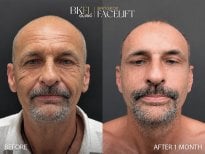Resultados antes y después de deep plane facelift en BKFL Clinic – rejuvenecimiento facial visible