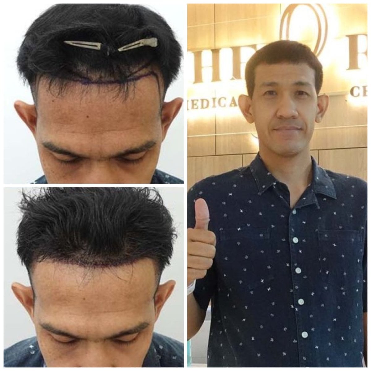 نتائج زراعة الشعر قبل وبعد في قسم الجلدية والجراحة - مستشفى نافامين9