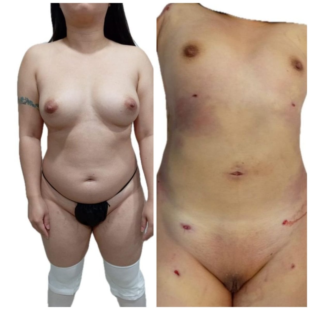 Resultados de liposucción antes y después en Hospital de la Familia, mejora visible del contorno
