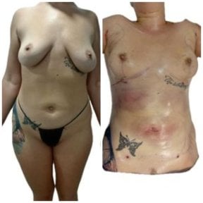 before-after photo liposuction