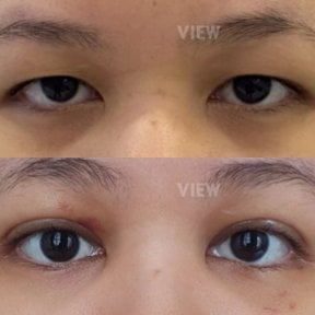 Resultados de blefaroplastia inferior antes y después en View Plastic Surgery Hospital