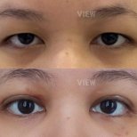 Resultados de blefaroplastia inferior antes y después en View Plastic Surgery Hospital