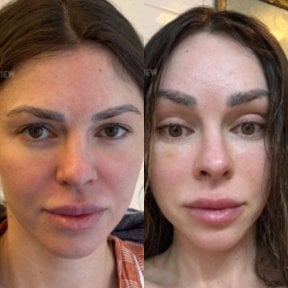Resultados de blefaroplastia de párpado inferior antes y después en View Plastic Surgery Hospital