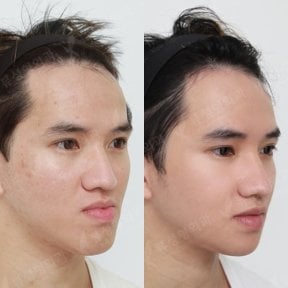 Before and after orthognathic surgery results at View Plastic Surgery Hospital, jawline improved