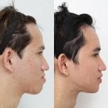 Before and after orthognathic surgery results at View Plastic Surgery Hospital, jaw alignment