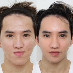 Before and after orthognathic surgery result at View Plastic Surgery Hospital, facial contouring