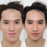 Before and after orthognathic surgery result at View Plastic Surgery Hospital, facial contouring