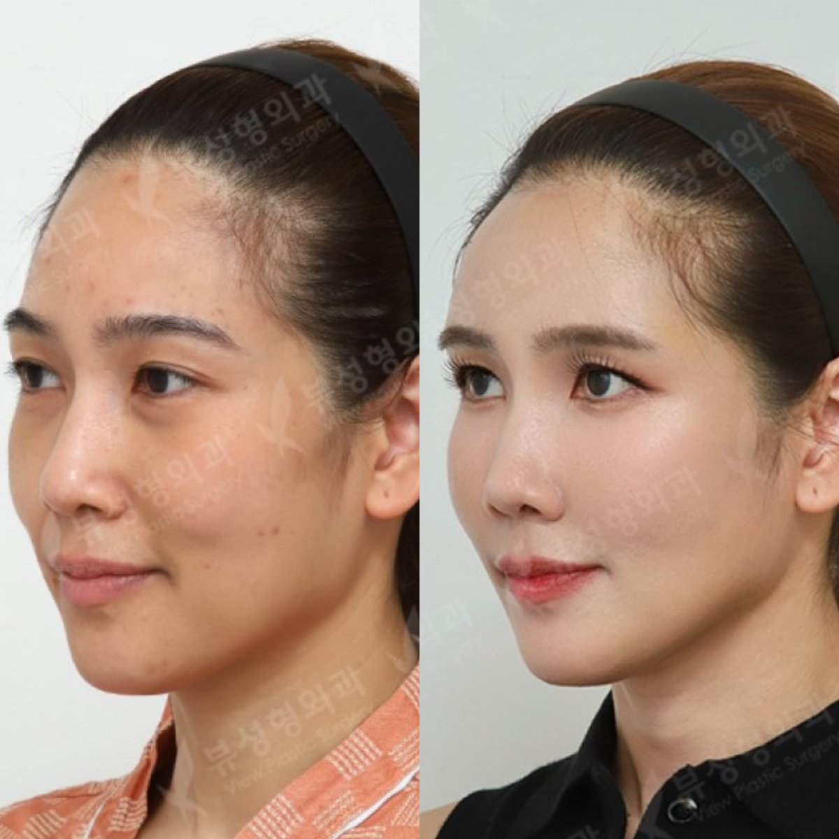 Resultados de lipofilling facial antes y después en View Plastic Surgery Hospital, mayor volumen
