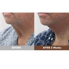 before-after photo glubokaya-podtyazhka-lica-deep-plane-facelift