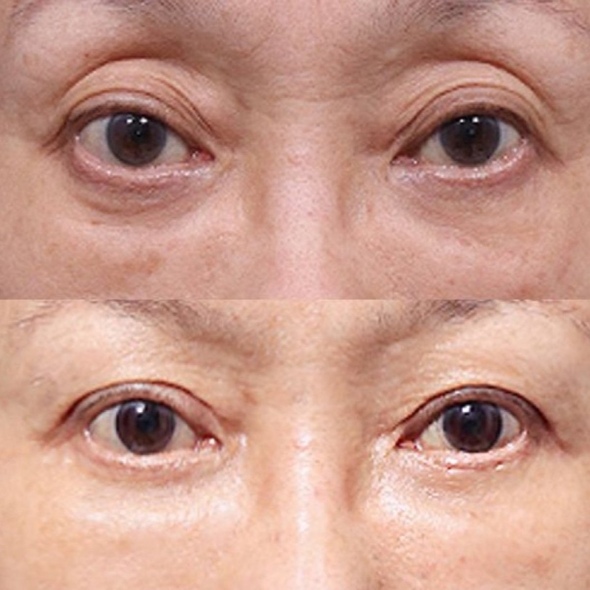 Resultados antes y después de cirugía de párpado caído en VG Plastic Surgery, ojos mejorados