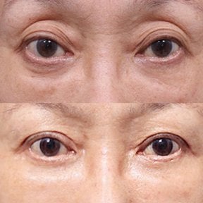 before-after photo droopy-eyelid-surgery