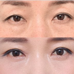 before-after photo droopy-eyelid-surgery