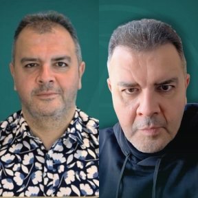 Before and after DHI hair transplant results, improved hair density and natural hairline