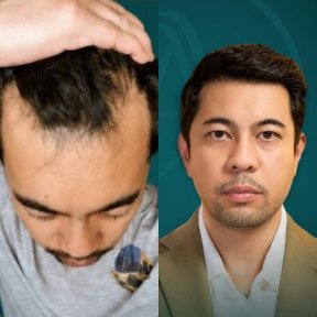 Before and after DHI hair transplant results – restored hairline and fuller hair