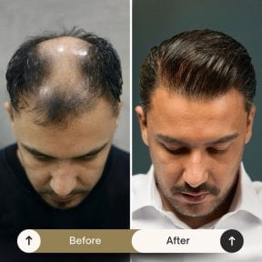 DHI hair transplant before and after results – restored hairline and fuller hair coverage