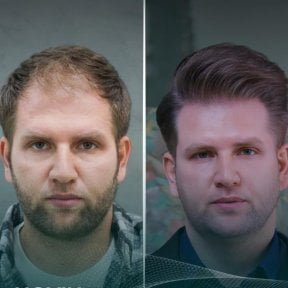 Before and after DHI hair transplant results – restored hairline and fuller hair