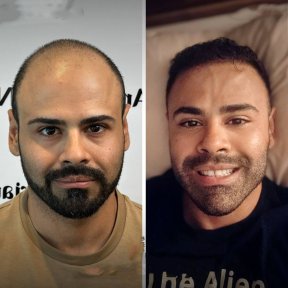 Before and after DHI hair transplant results – restored hairline and fuller hair