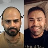 Before and after DHI hair transplant results – restored hairline and fuller hair