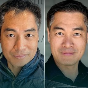 Before and after DHI hair transplant results, improved hair density and natural hairline