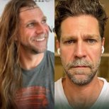 Before and after DHI hair transplant results in male patient – improved hair density