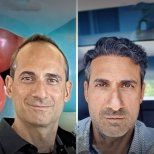 Before and after DHI hair transplant results in male patient – restored hairline and density
