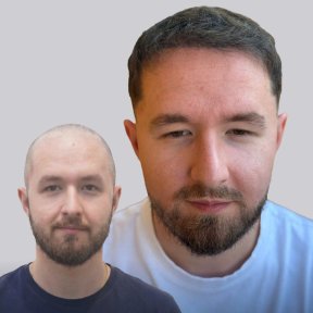 Before and after stem cell hair transplant results – restored hairline and fuller hair