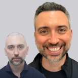 Before and after stem cell hair transplant results – restored hairline and fuller hair