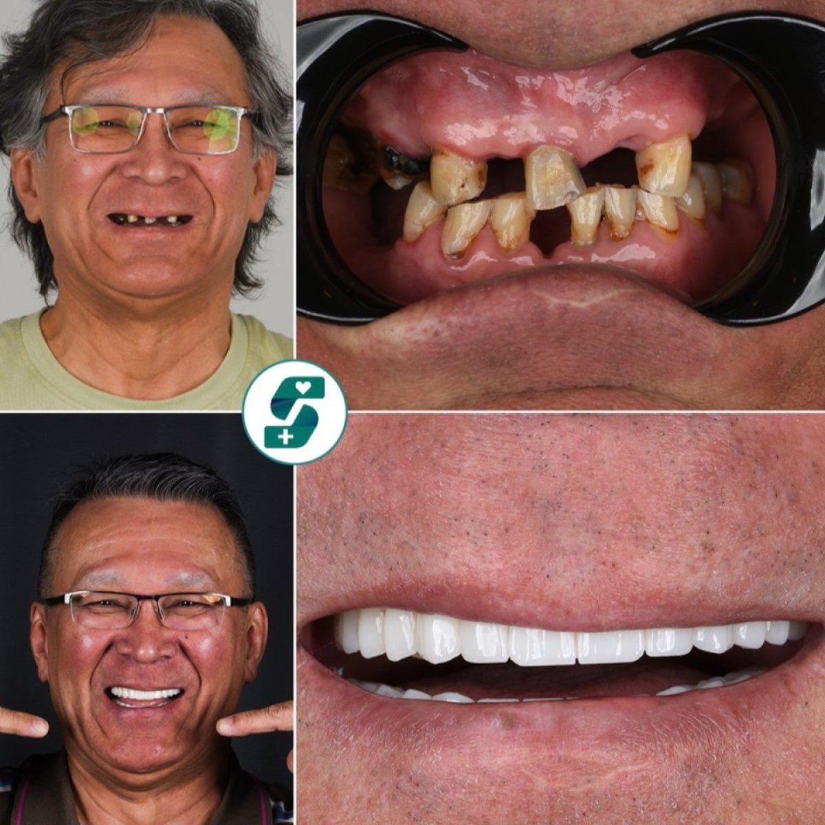 Antes y después de implantes dentales All-on-4 en Soraca Med – restauración total de sonrisa