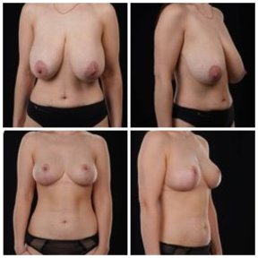 before-after photo mastopeksia-podtazka-grudi-konturnaa-plastika