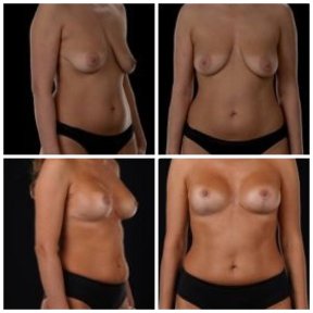 before-after photo mastopeksia-podtazka-grudi-konturnaa-plastika