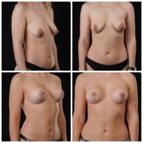 before-after photo mastopeksia-podtazka-grudi-konturnaa-plastika