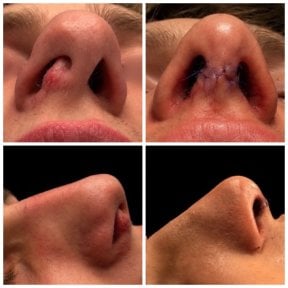 before-after photo rinoplastika-plastika-nosa