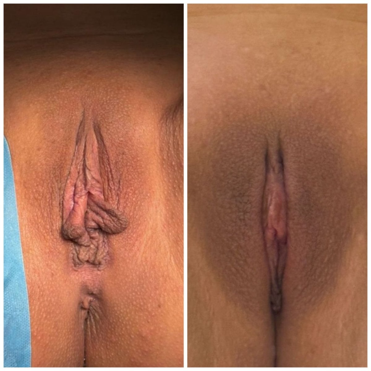 نتائج قبل وبعد عملية تجميل الشفرين في عيادة Assoc. Prof. Dr. Esra Özbaşlı OBGYN & Women Genital Aesthetics