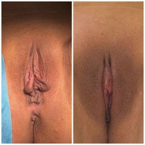 before-after photo labiaplasty