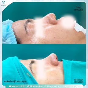 before-after photo rinoplastika-plastika-nosa