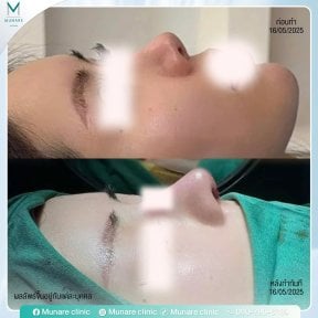 before-after photo rinoplastika-plastika-nosa