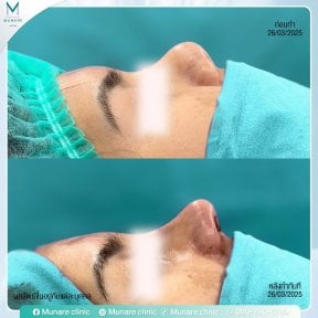 before-after photo rinoplastika-plastika-nosa
