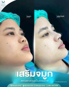 before-after photo rinoplastika-plastika-nosa