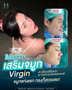 before-after photo rinoplastika-plastika-nosa