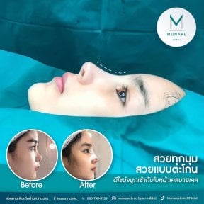 before-after photo rinoplastika-plastika-nosa