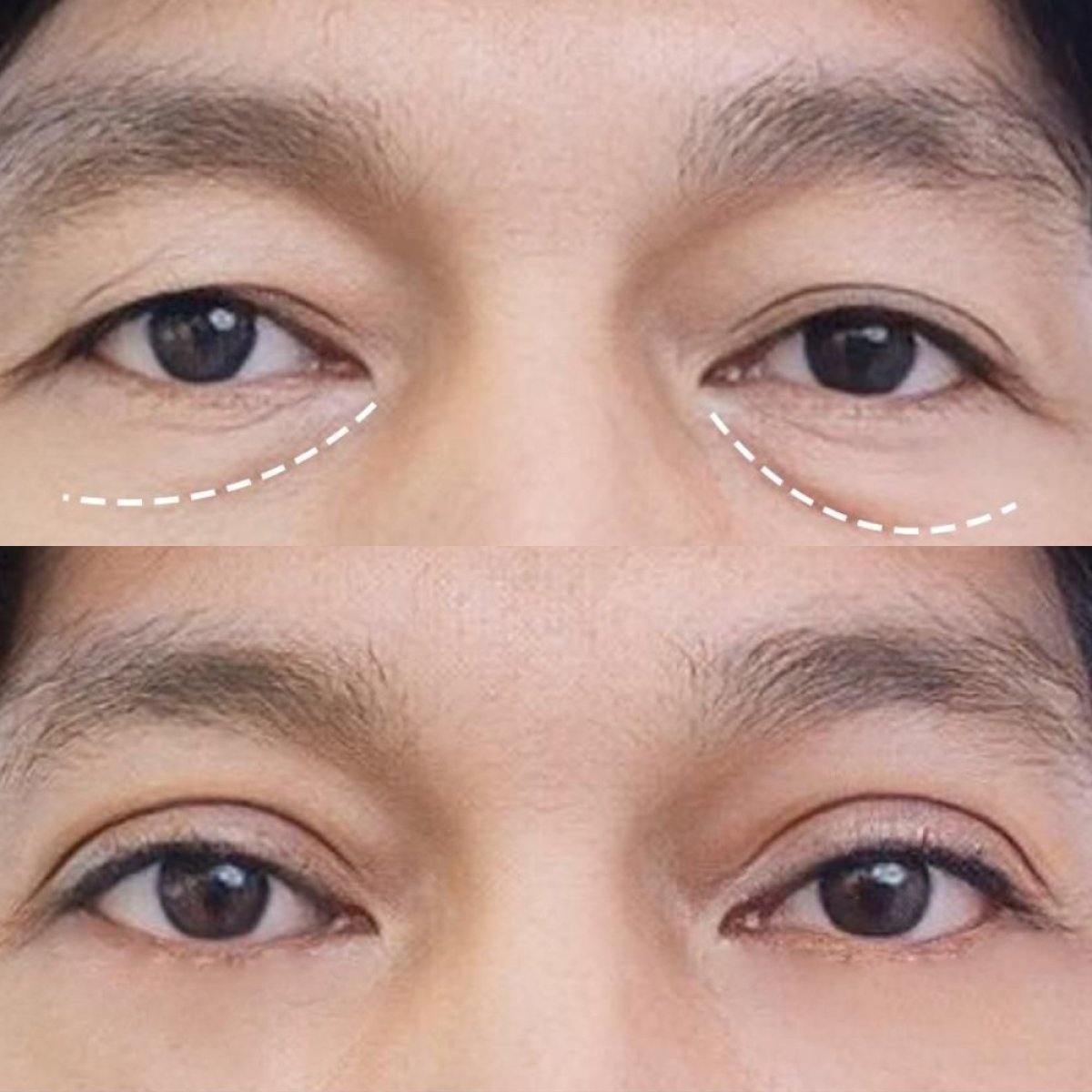 Resultados de blefaroplastia antes y después en Asia Cosmetic Hospital, corrección de párpados