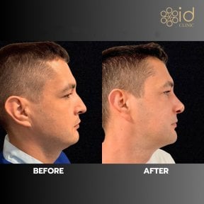 before-after photo rhinoplasty-nose-job