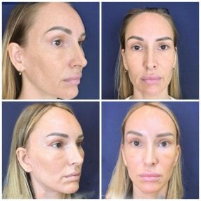 before-after photo tightening-of-facial-skin-facelift