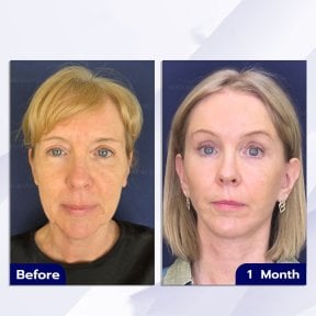 before-after photo tightening-of-facial-skin-facelift